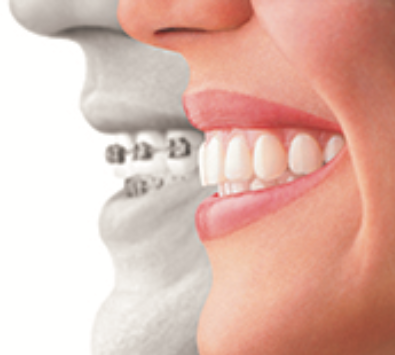 Photo of two smiling mouths with braces