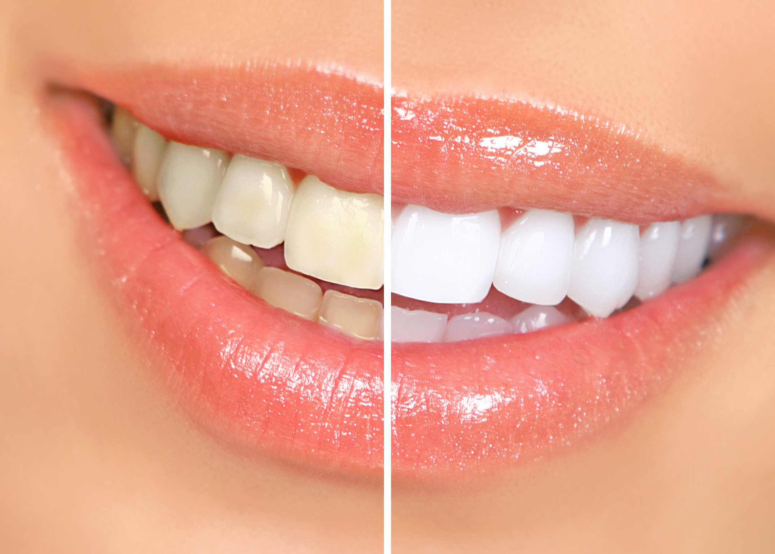 Teeth Whitening Side-by-Side photo