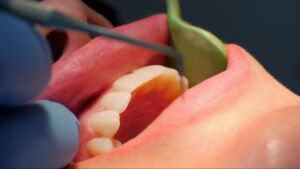 A close-up of a dentist checking the teeth of a young girl.