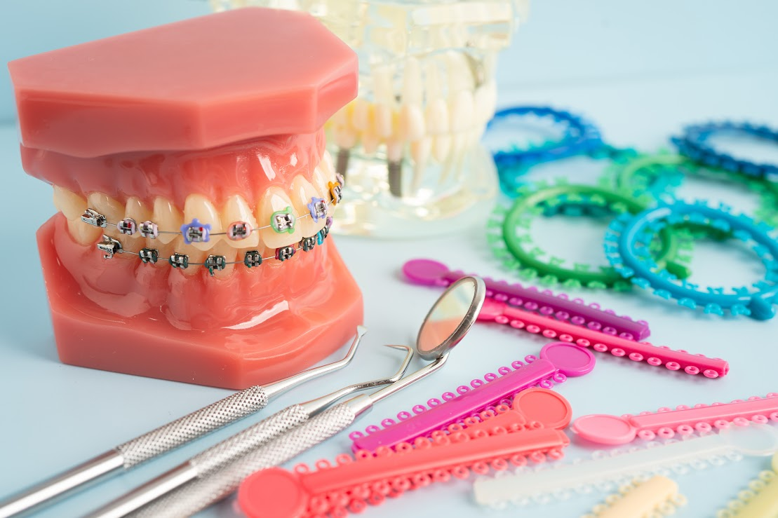 A model of a mouth with braces on its teeth is surrounded by braces supplies.