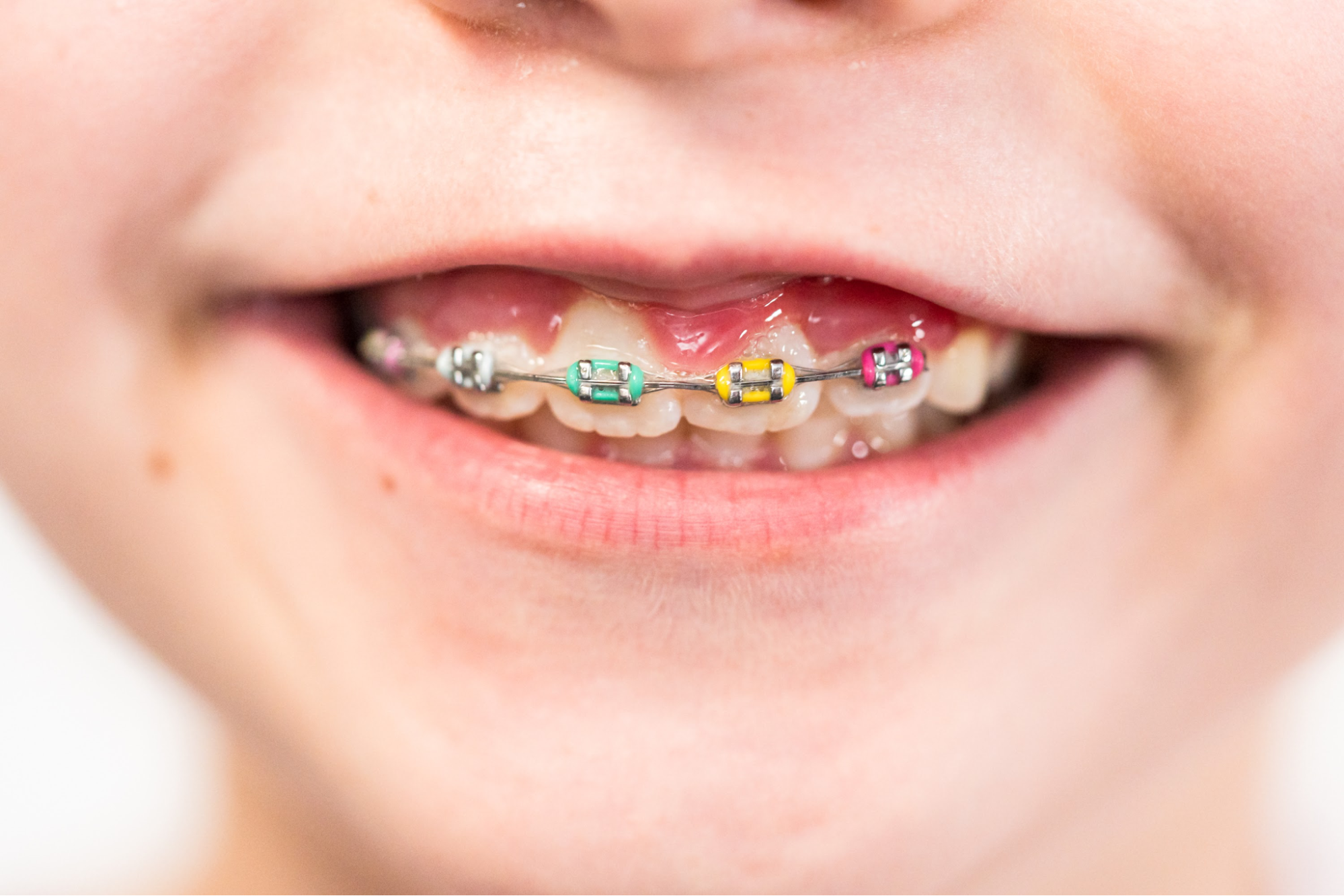 A kid wearing rainbow braces.