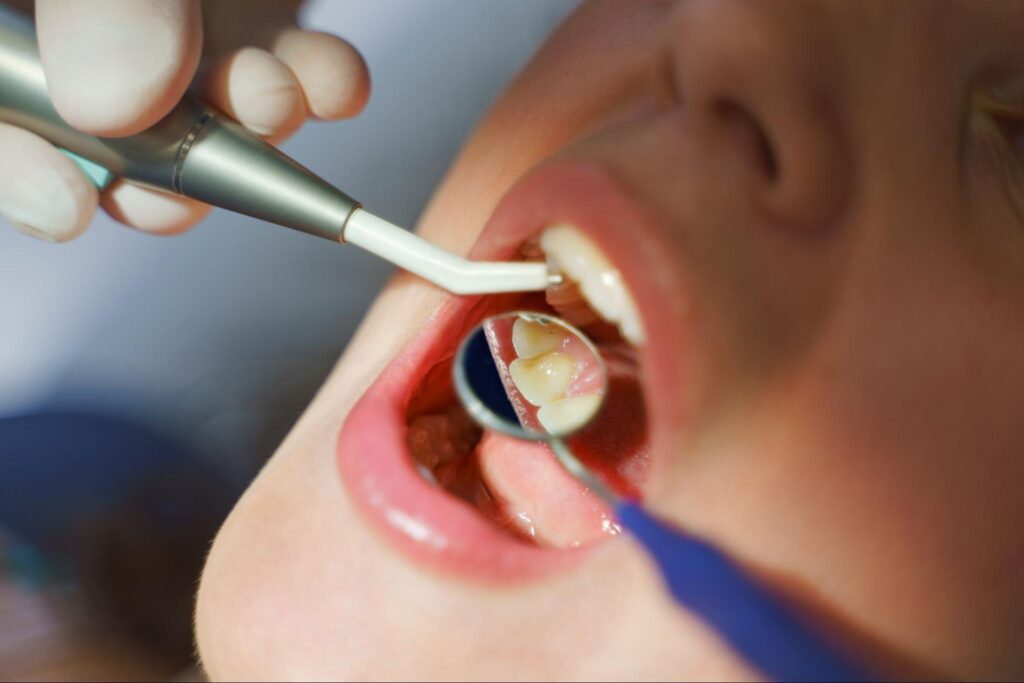 A close-up of a woman undergoing a dental checkup before a teeth whitening treatment.