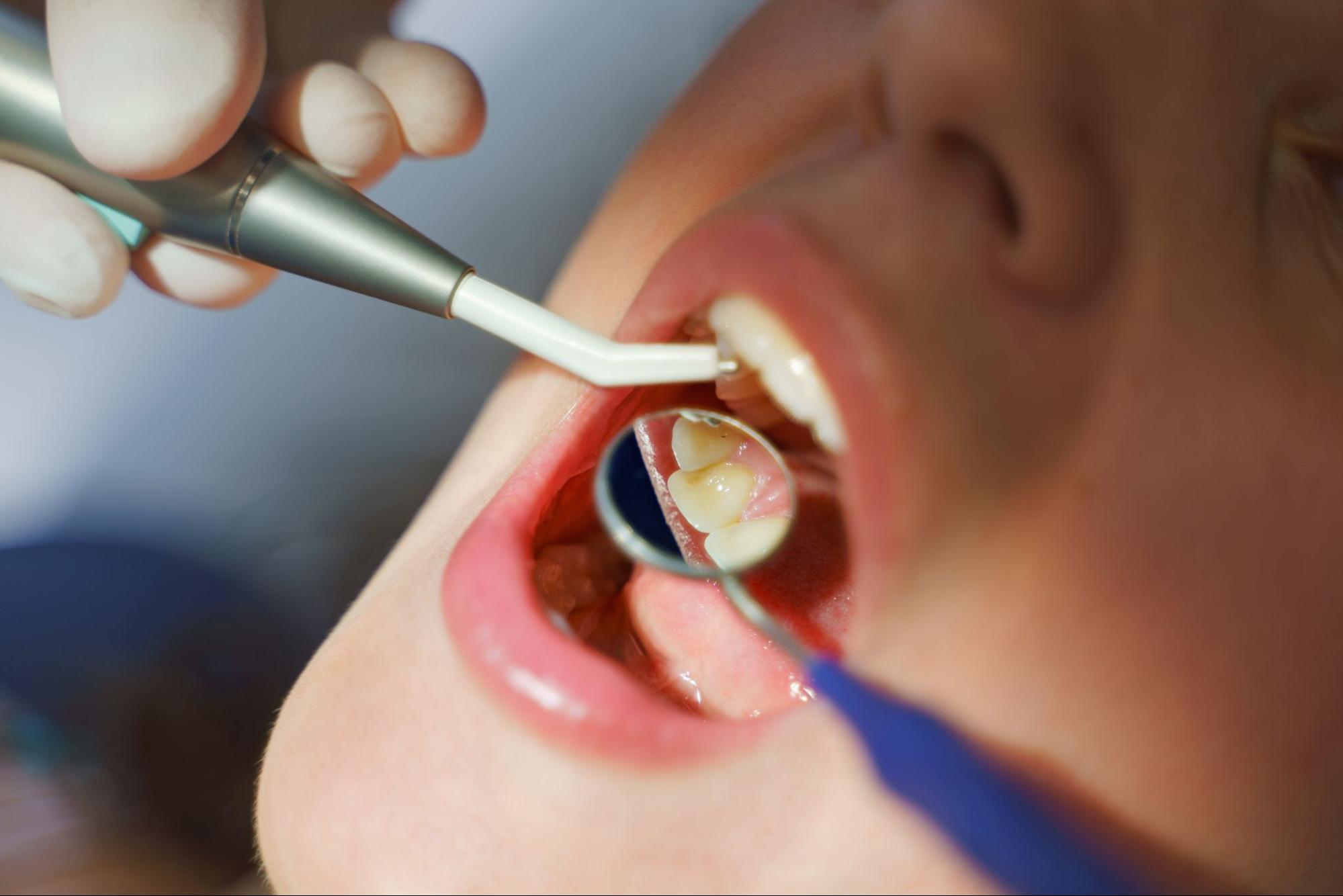 A close-up of a woman undergoing a dental checkup before a teeth whitening treatment. 